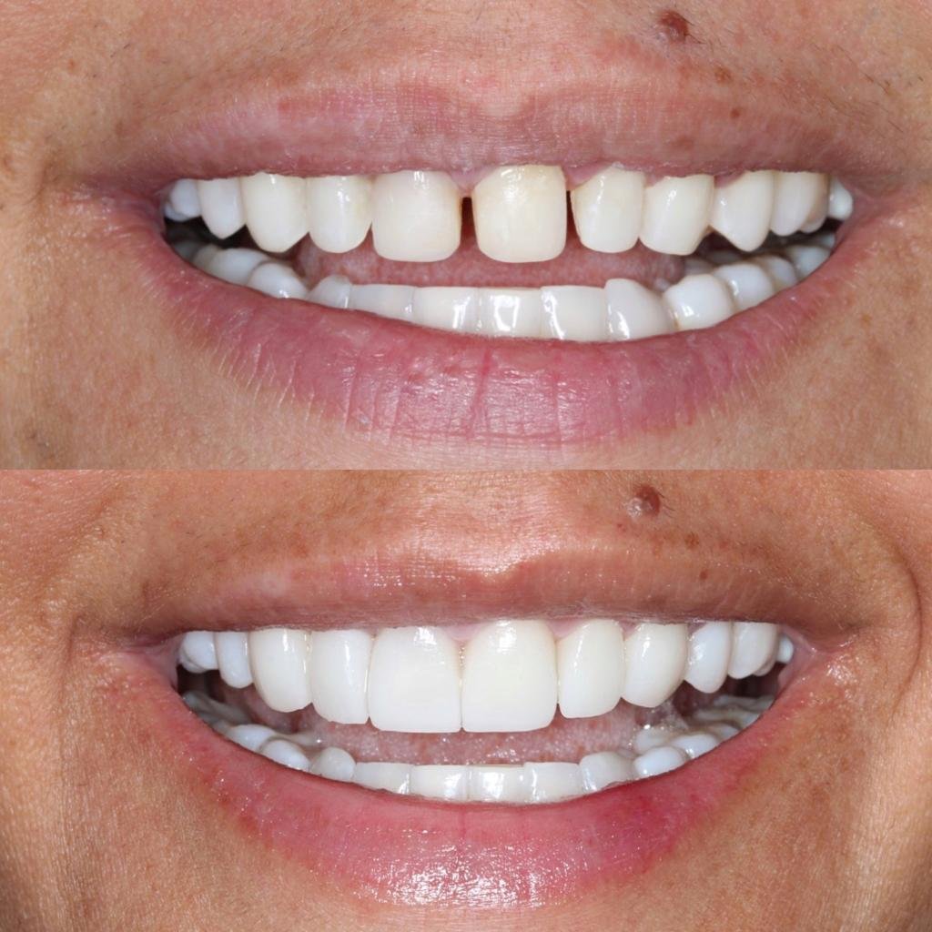 Before and After