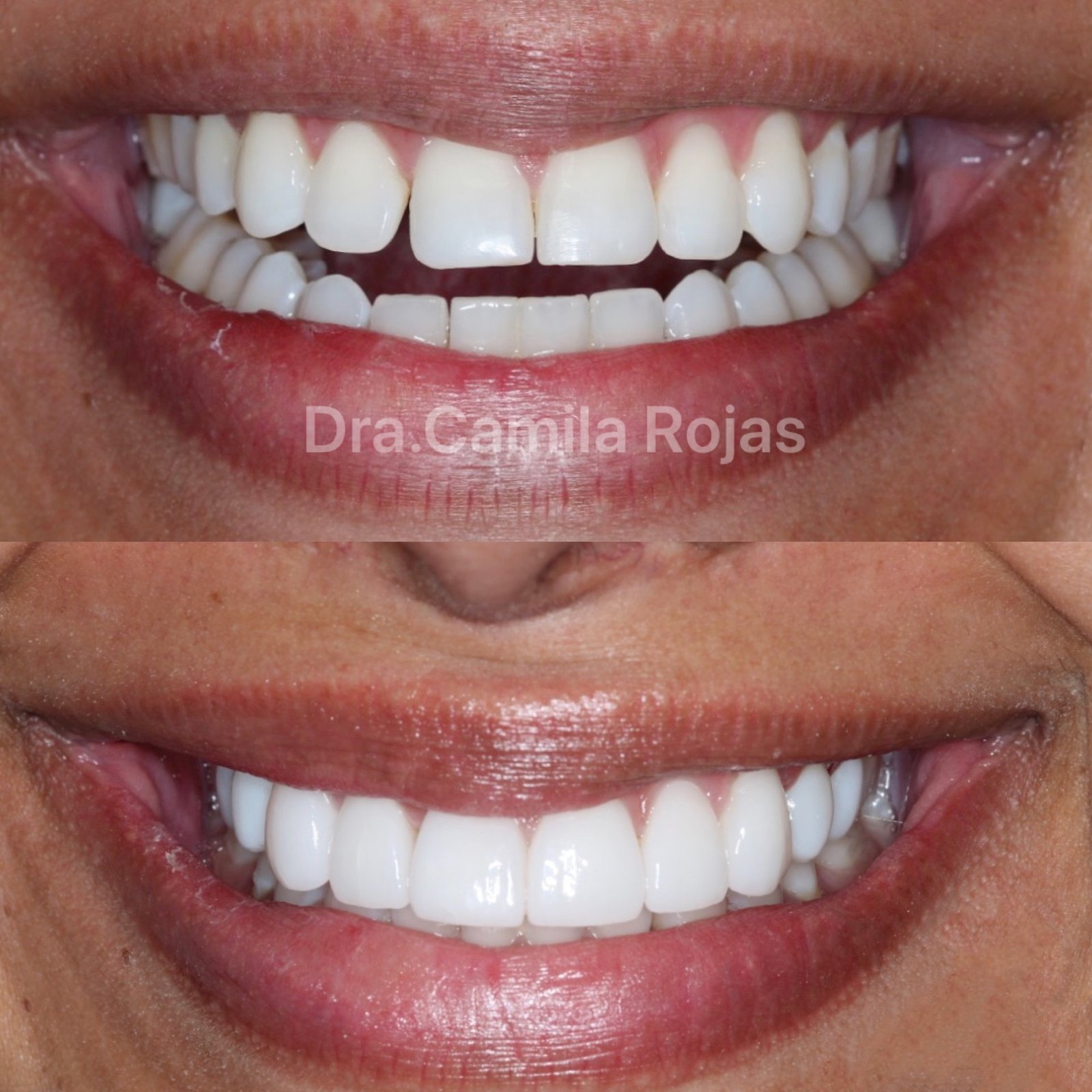 Before and after veneers
