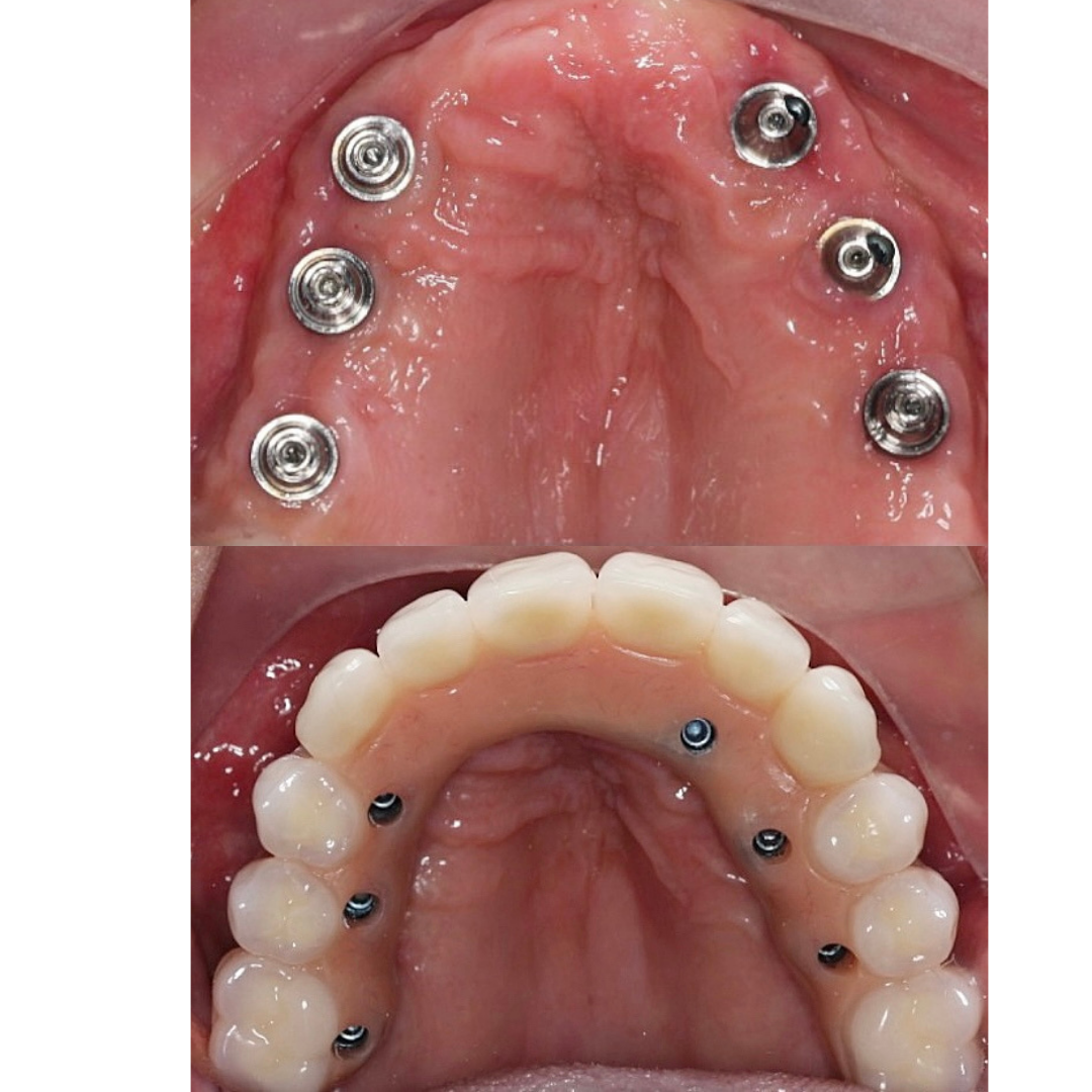 Protesis total sobre implantes
