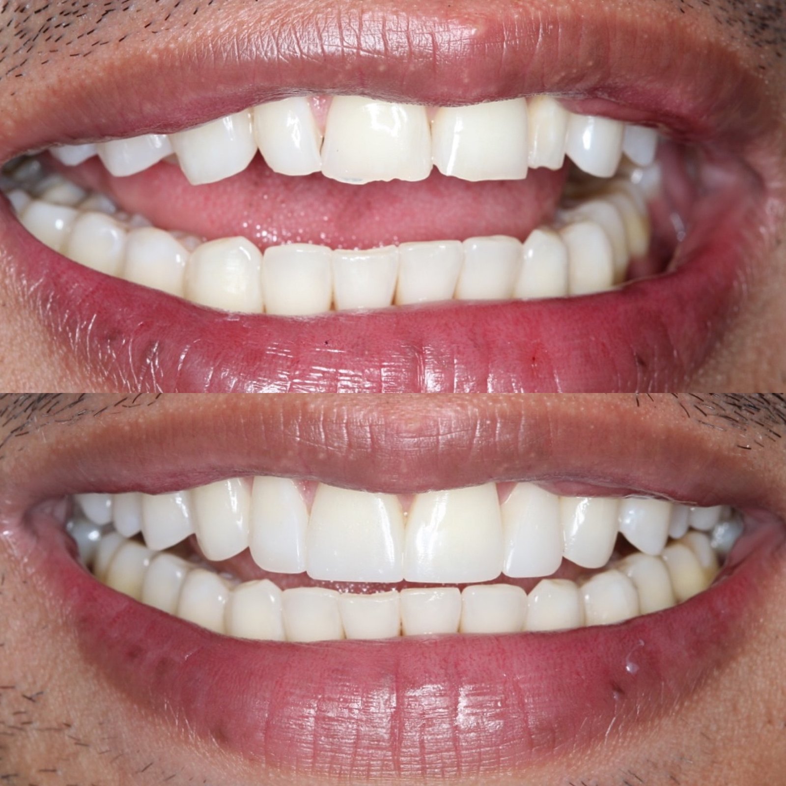 before and after smiling