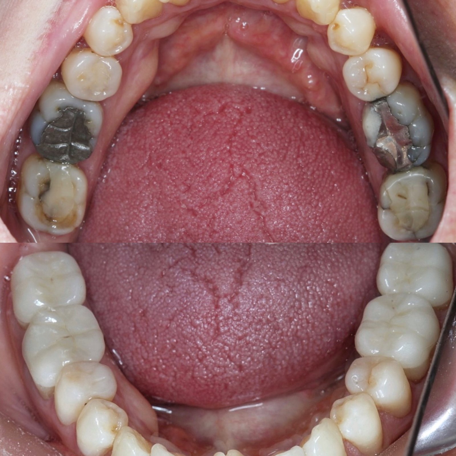 black fillings removing