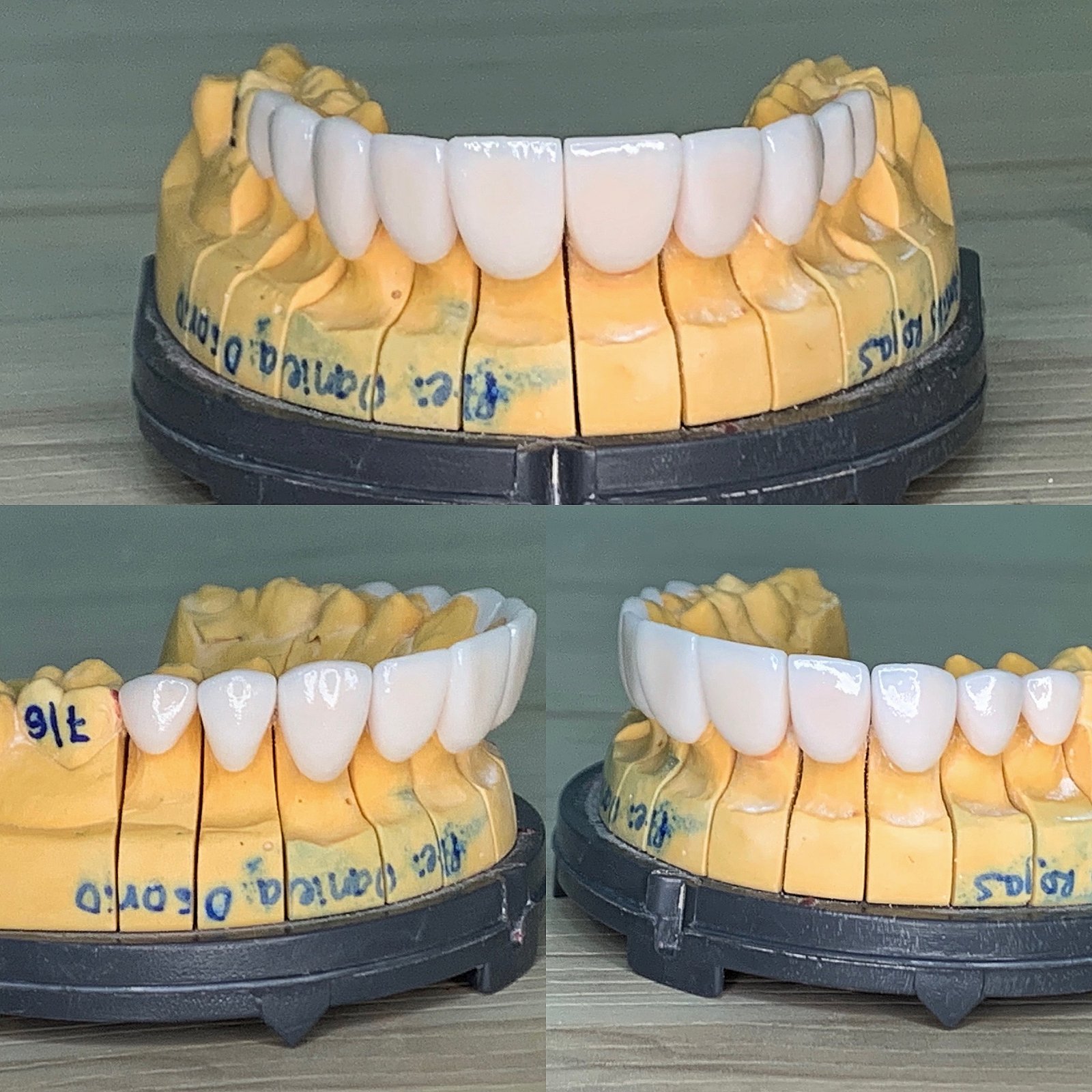 veneers ready to make a great smile