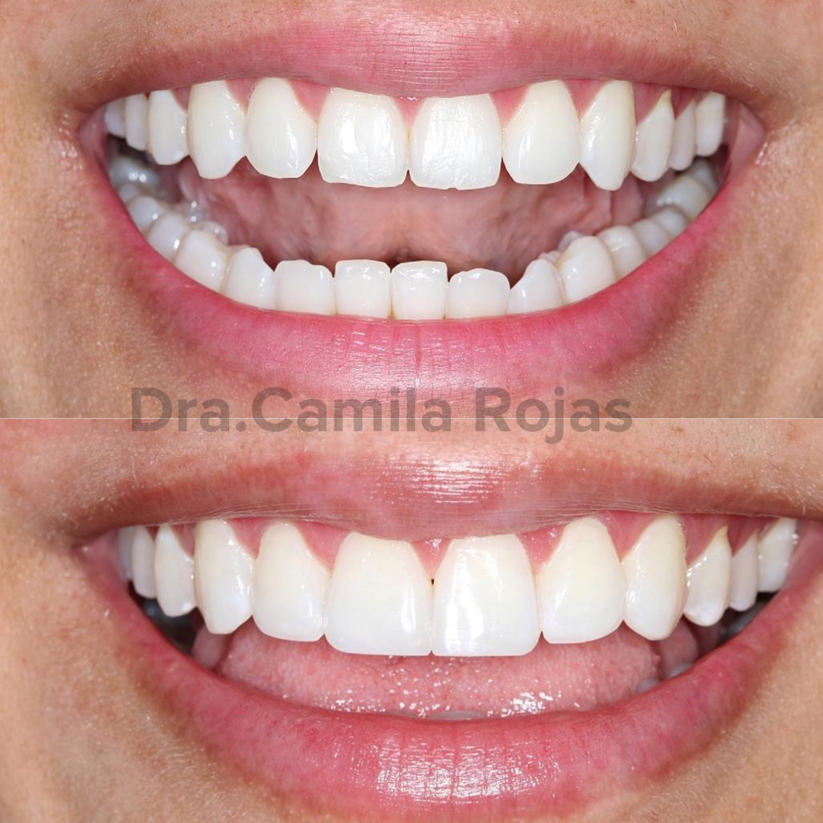 whitening and composite before and after