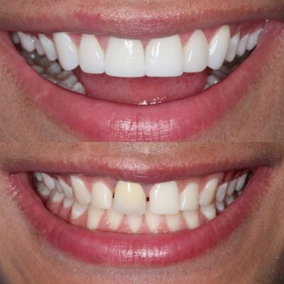 smile design before and after